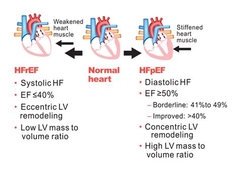 The Diagnosis Pcna Heart Failure Guide