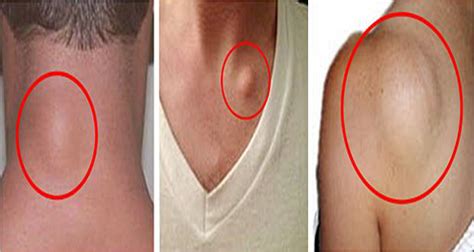 Get Rid Of Skin Lumps Naturally Extreme Natural Health News