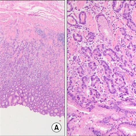 Gross Image Of Resected Specimen A Gastric Adenocarinoma White Download Scientific Diagram