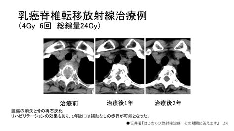 Vol7 骨への転移の放射線治療 1回での治療もできます！ 社会医療法人美杉会／社会福祉法人美郷会