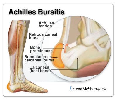 Achilles Bursitis