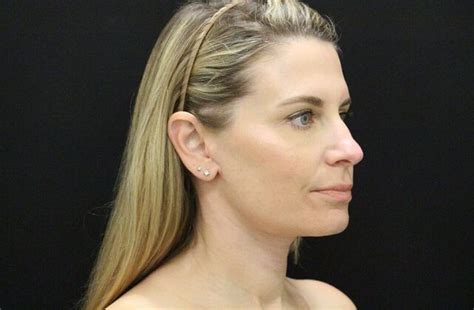 Case Face Neck Lifts Before And After Gallery