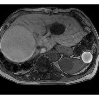 MRI of the abdomen with/without contrast (04-01-2011). (a) A... | Download Scientific Diagram