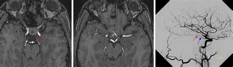 Anterior Choroidal Artery | neuroangio.org