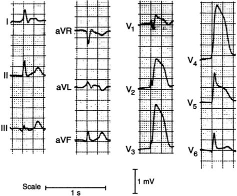 Ecg Showing An Acute Anterolateral Myocardial Infarction Download Scientific Diagram