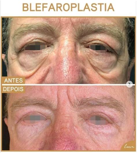 45 Fotos De Blefaroplastia Antes E Depois Do Procedimento