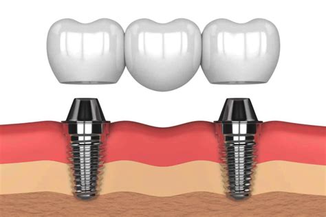 Puente Sobre Implantes Dentales Clinica Dental Palomero