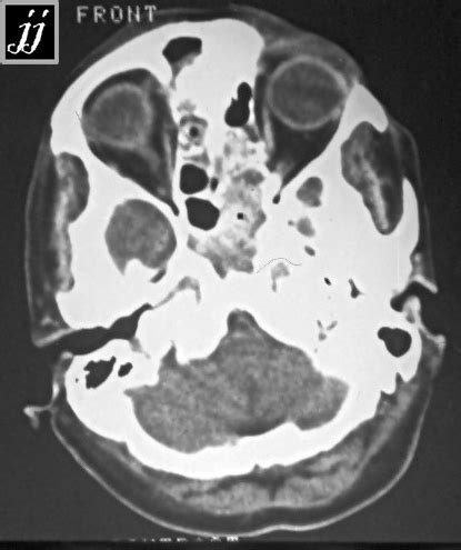 ENT – Nasal osteoma and sinusitis – Radioogle