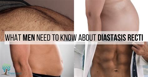 Diastasis Recti In Men Learn About Causes And Treatment Hot Sex Picture