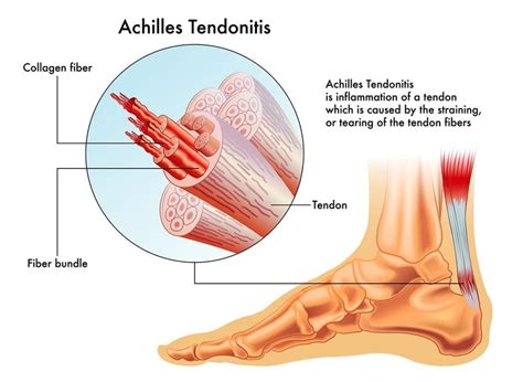 Achilles Tendinopathy Enable Podiatry