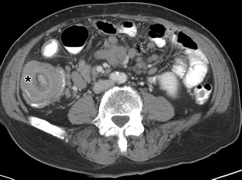 Colonic Intussusception Clinical And Radiographic Features Ajr