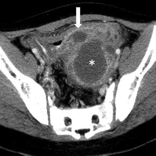 Case 1 Axial CT Of The Pelvis In The First Patient Reveals A