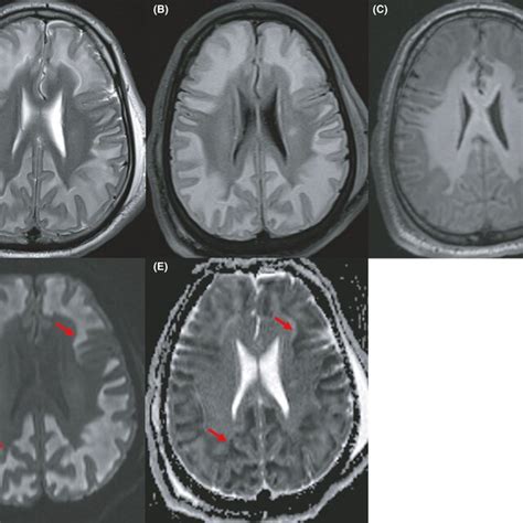 Axial Brain Magnetic Resonance Images Showing Putaminal Hemorrhagic