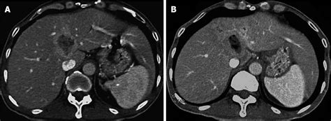 Figure From Endoscopic Ultrasound Guided Ethanol Ablation Therapy For