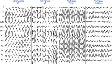 Polymorphic Ventricular Tachycardia Vs Monomorphic