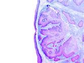 Prognosis and Diagnosis of Hepatocellular Carcinoma | Frontiers ...