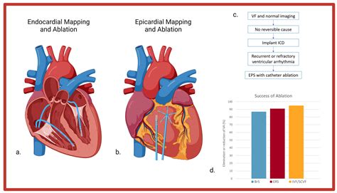 Jcdd Free Full Text Trigger And Substrate Mapping And Ablation For Ventricular Fibrillation