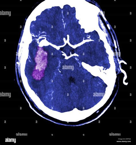 Tomografía Axial Computarizada (TAC) del cerebro mostrando una ruptura ...