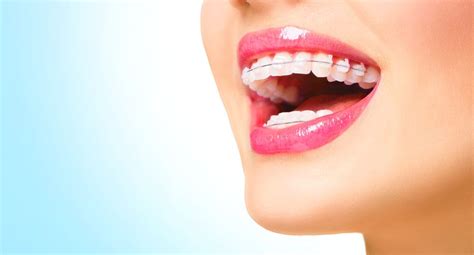 Braces American River Dental Rancho Cordova Dentist