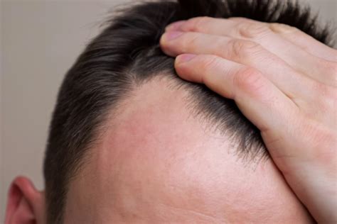 What Is Androgenetic Alopecia The Lumen Center Philadelphia