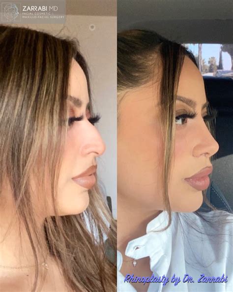 Piezo Ultrasonic Rhinoplasty Dr Shahrouz Zarrabi Md