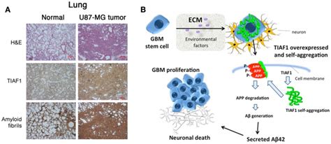 A Postulated Model For Gbm Malignancy A U87 Mg Glioma Cells Were