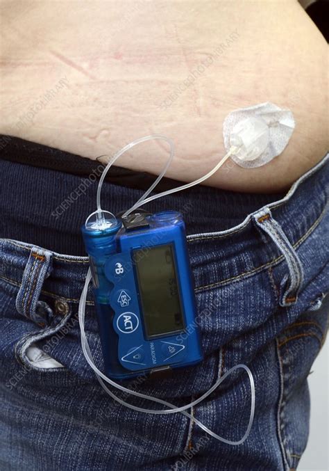 Insulin Delivery Pump Stock Image C016 6870 Science Photo Library