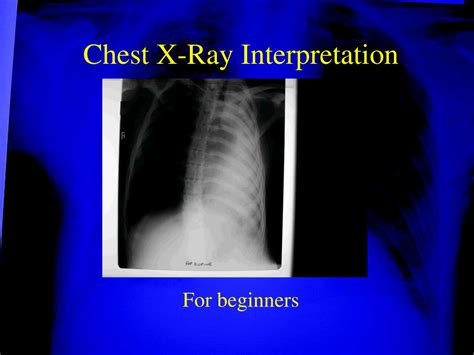 PPT - Chest X-Ray Interpretation PowerPoint Presentation, free download - ID:6880489