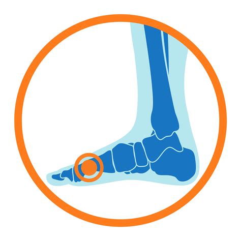 Sprains Foot Ankle Centers Of Frisco And Plano