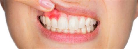 Gingivitis qué es y cómo prevenirla