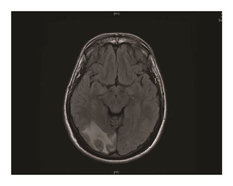 Brain Mri With Contrast Showed Right Parieto Occipital Cortical And Download Scientific Diagram