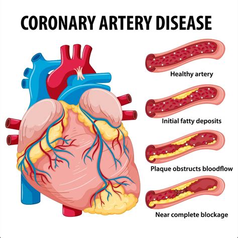 Coronary Artery Disease Causes Risk Factors Symptoms Treatment