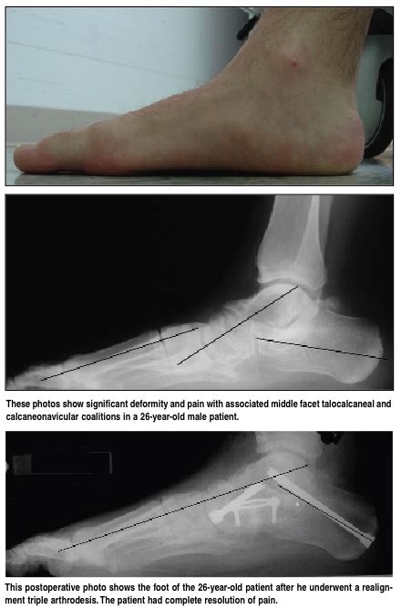 Current Concepts In Tarsal Coalition Surgery