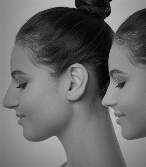 Nonsurgical Rhinoplasty Pasadena CA Dr Nima Facial Plastic Surgery