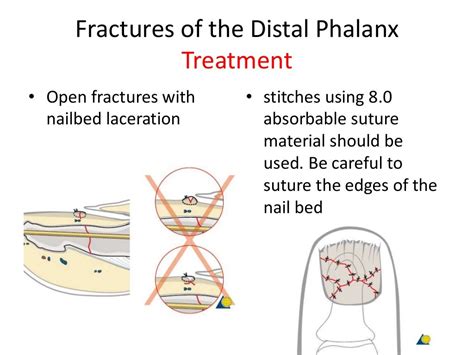 Distal phalanx fracture