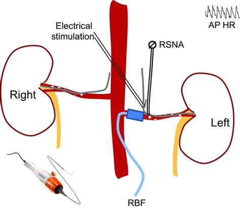 Reinnervation Following Catheter‐based Radio‐frequency Renal Denervation Booth 2015