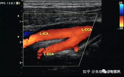 血管超声检查技术 知乎