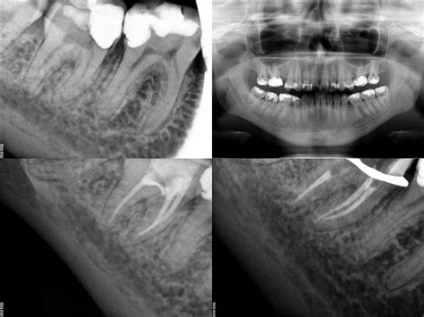 Leczenie Kana Owe Pod Mikroskopem Warszawa Moje Prace Endodontyczne