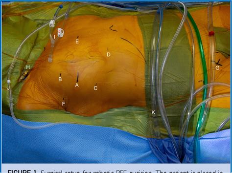 Figure From A Case Series Of Minimally Invasive Robotic Assisted