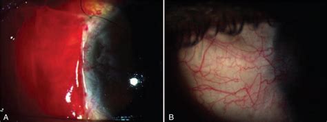 Postoperative Slit Lamp Photographs Of Case A On Postoperative Day