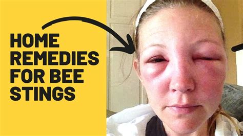 Bee sting swelling after 24 hours - kaslgd