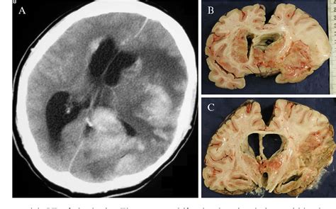 Figure 1 From Fatal Granulomatous Amoebic Meningoencephalitis Due To Balamuthia Mandrillaris