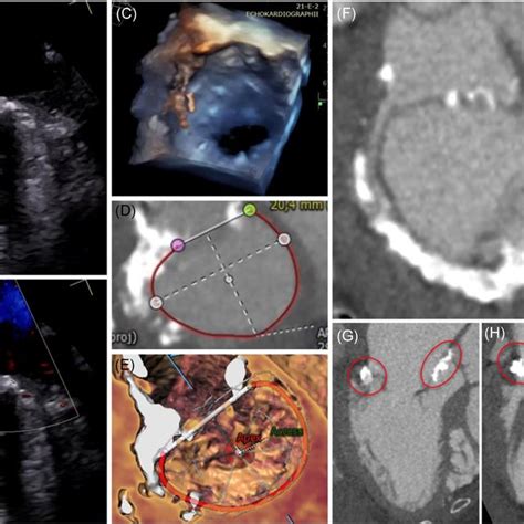 Valve‐in‐ring Transcatheter Mitral Valve Implantation With Lampoon