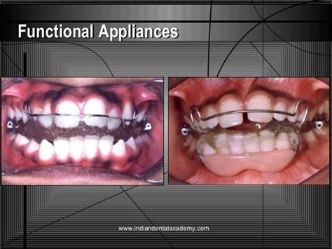 Advances In Orthodontics Certified Fixed Orthodontic Courses By Indi