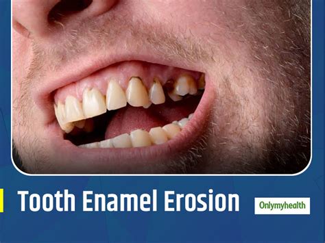 4 Common Tooth Enamel Erosion Symptoms Listerine