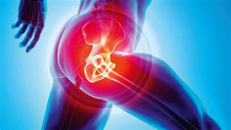 Hip replacement: the pros and cons of early surgery | The Chartered