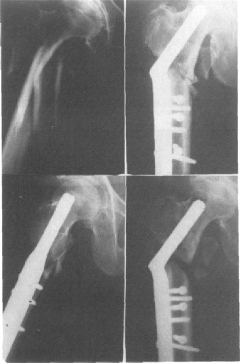 Figure 2 From Fracturas Laterales Inestables Del Cuello De Fémur