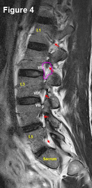 Read Your MRI Basic Education from a World-Renowned Spine Expert ...