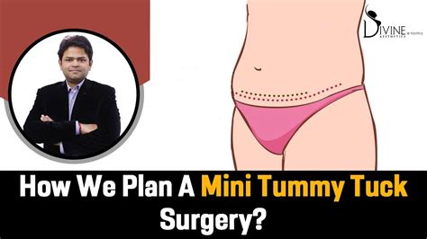 How We Plan Mini Tummy Tuck Surgery Youtube