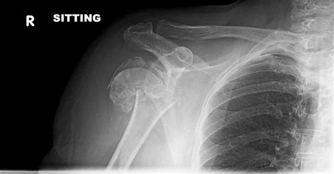 Orthodx Humerus Fracture After Slipping On Ice Clinical Advisor